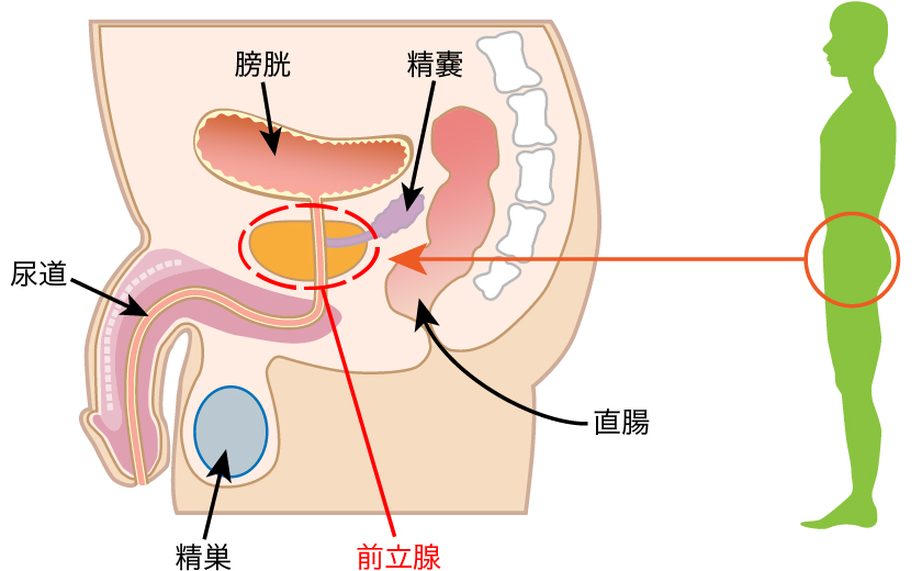 前立腺肥大症