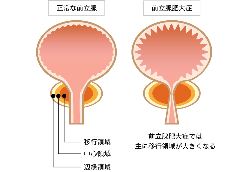 前立腺肥大症