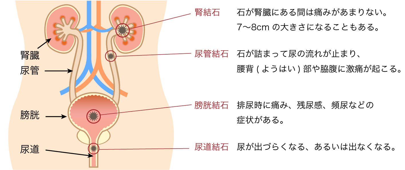 脇腹 痛み ストレス 右